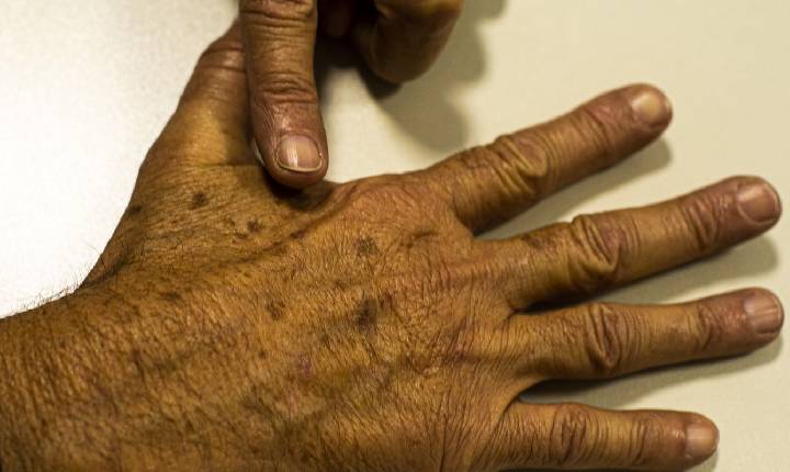 Desinformação sobre câncer de pele afeta diagnóstico, diz instituição